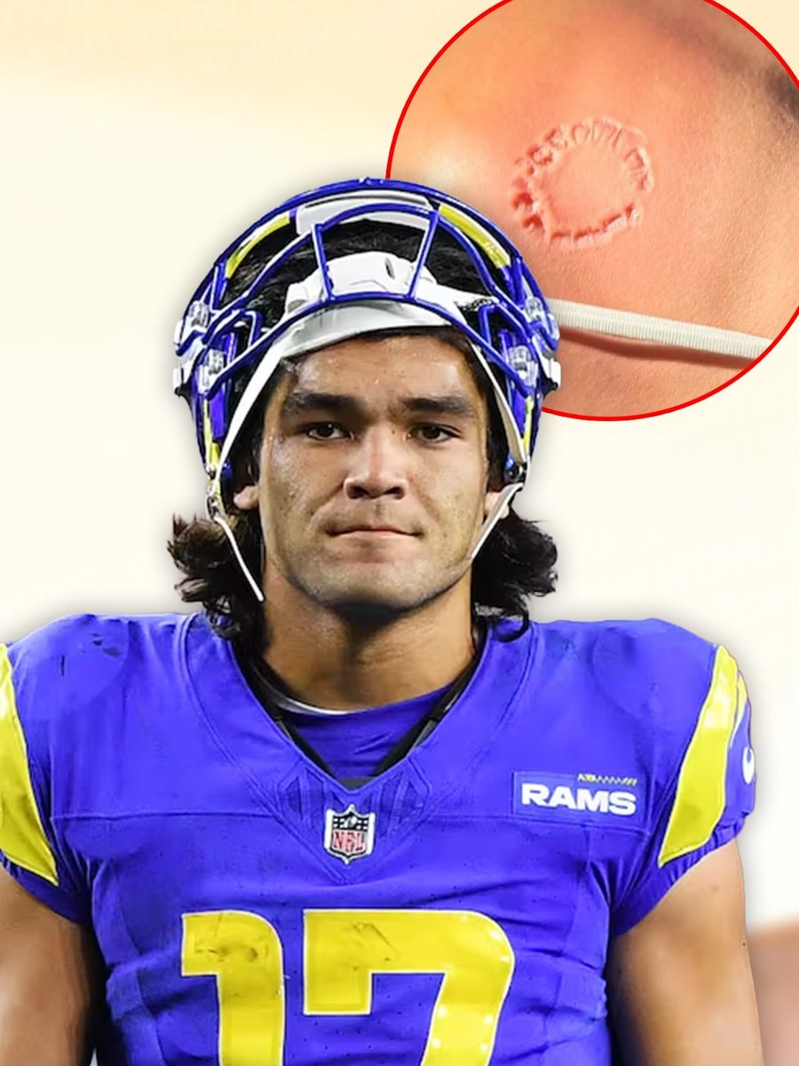 Puka Nacua bite mark photos
