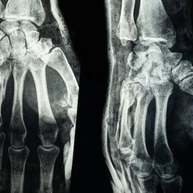 Bone glue fracture repair
