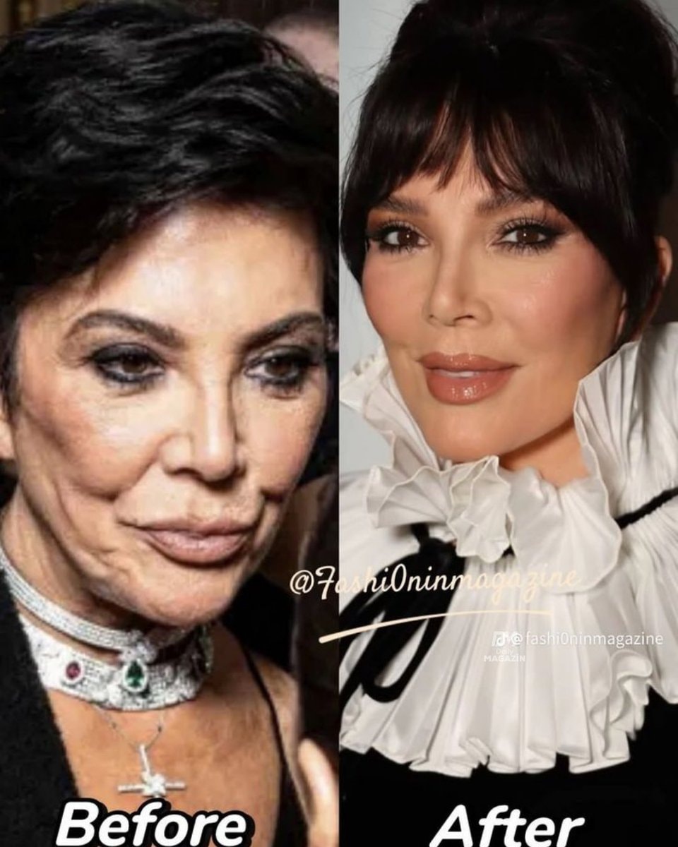 Kris Jenner age 70 aesthetic update