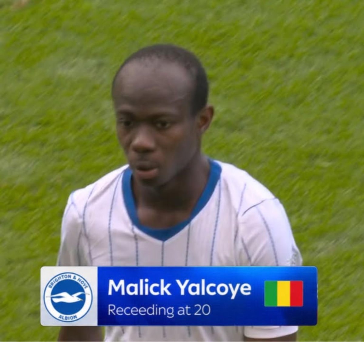 receding hairline at 20