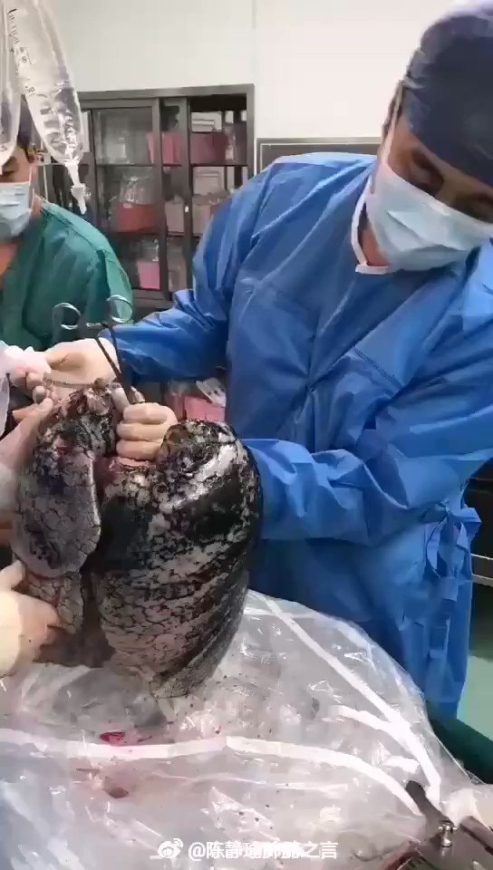 blackened lungs from 30 years of smoking