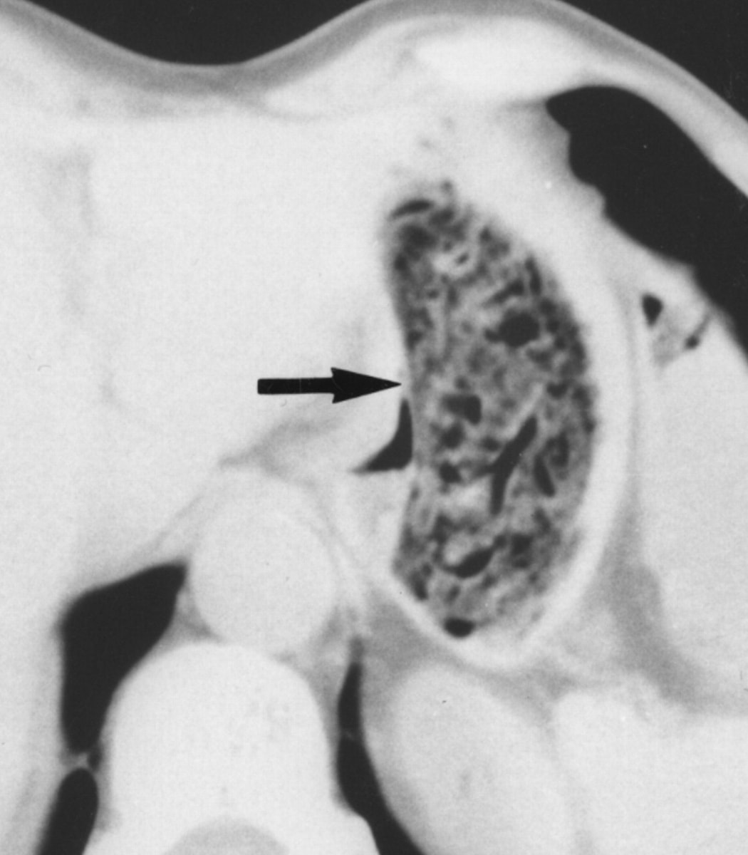 Diet Coke dissolves stomach mass (photo 2 of 2)