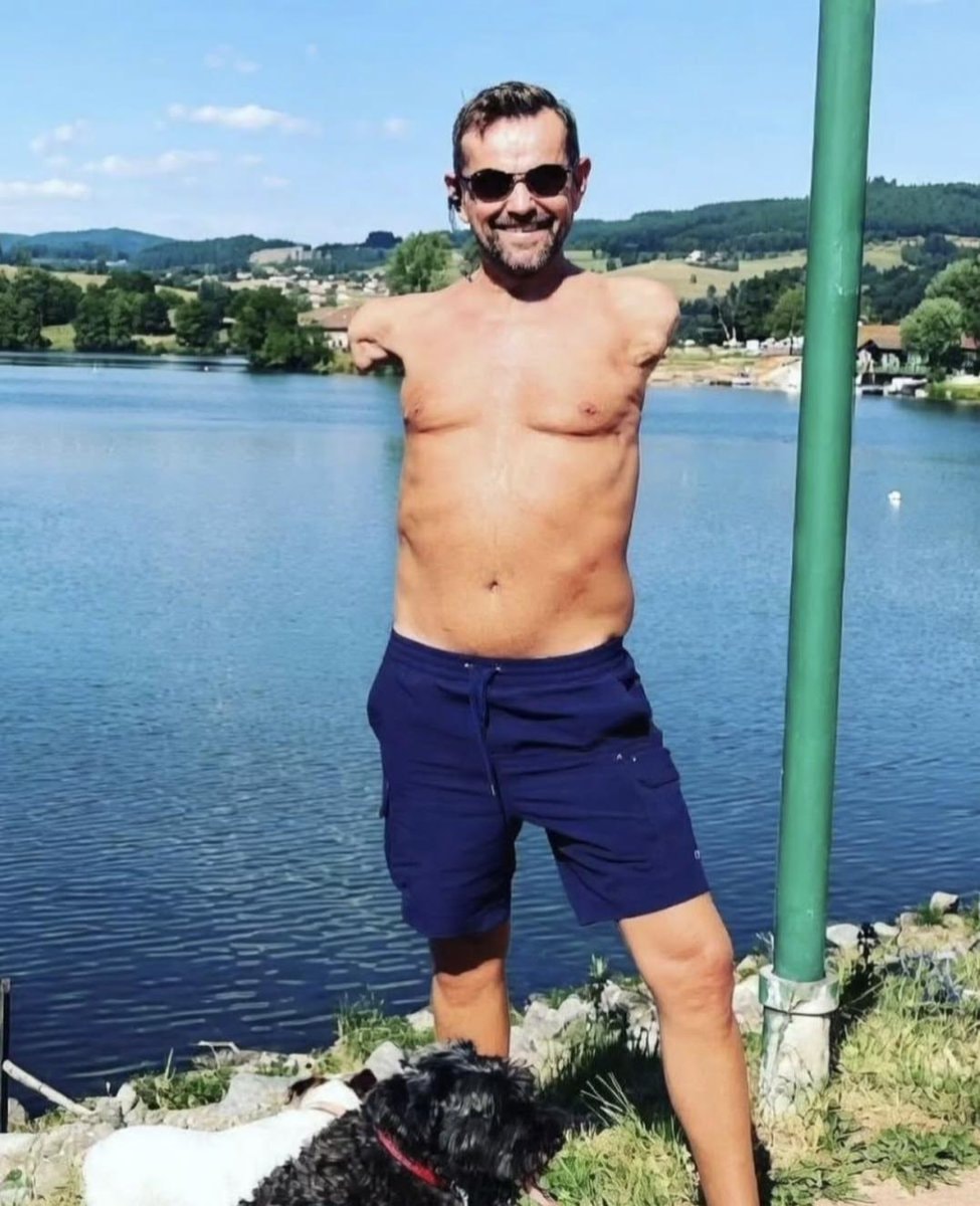 World's First Double Arm And Shoulder Transplant