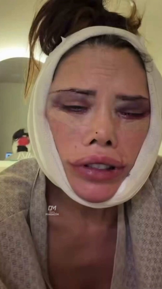 Didem Ceran surgery face transplant