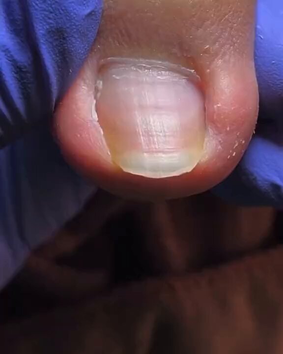 Ingrown nail pain close-up