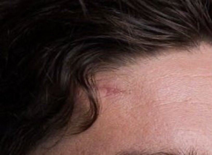 Federico Valverde World Cup photo scar visible (photo 2 of 2)