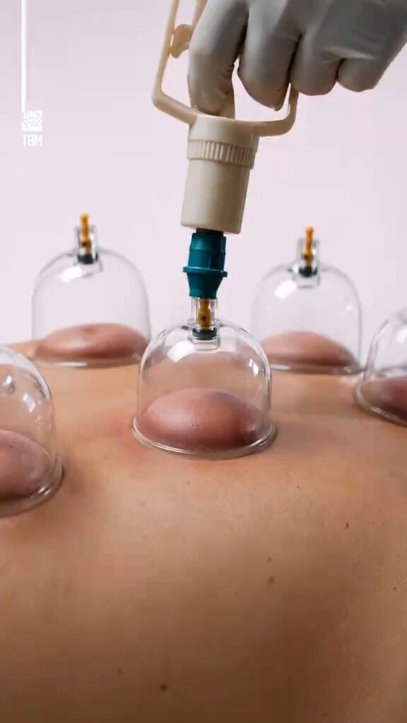 Hijama cupping therapy explained