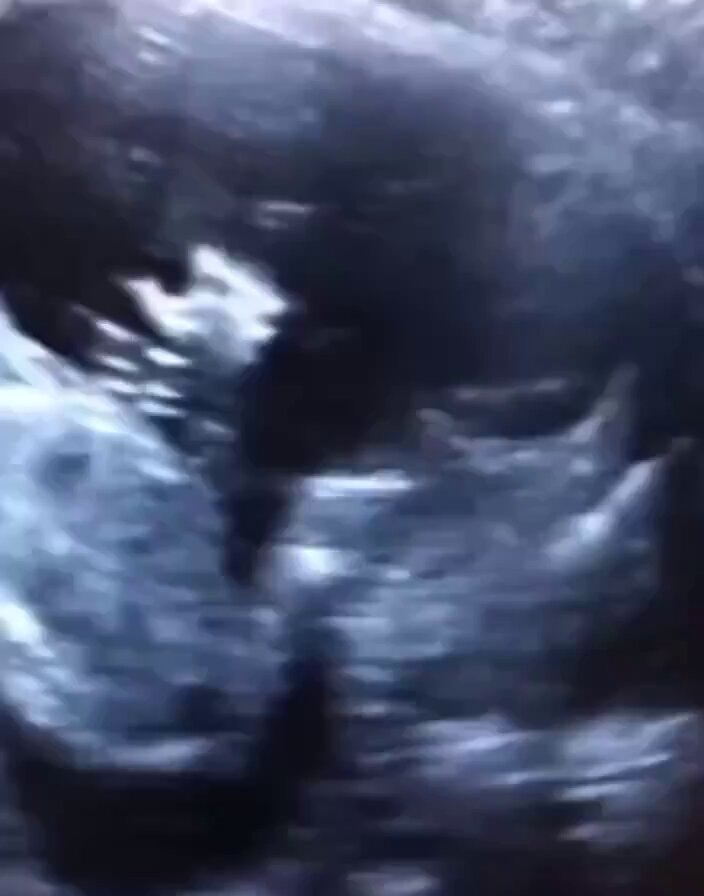 Fetal hand wave ultrasound comparison