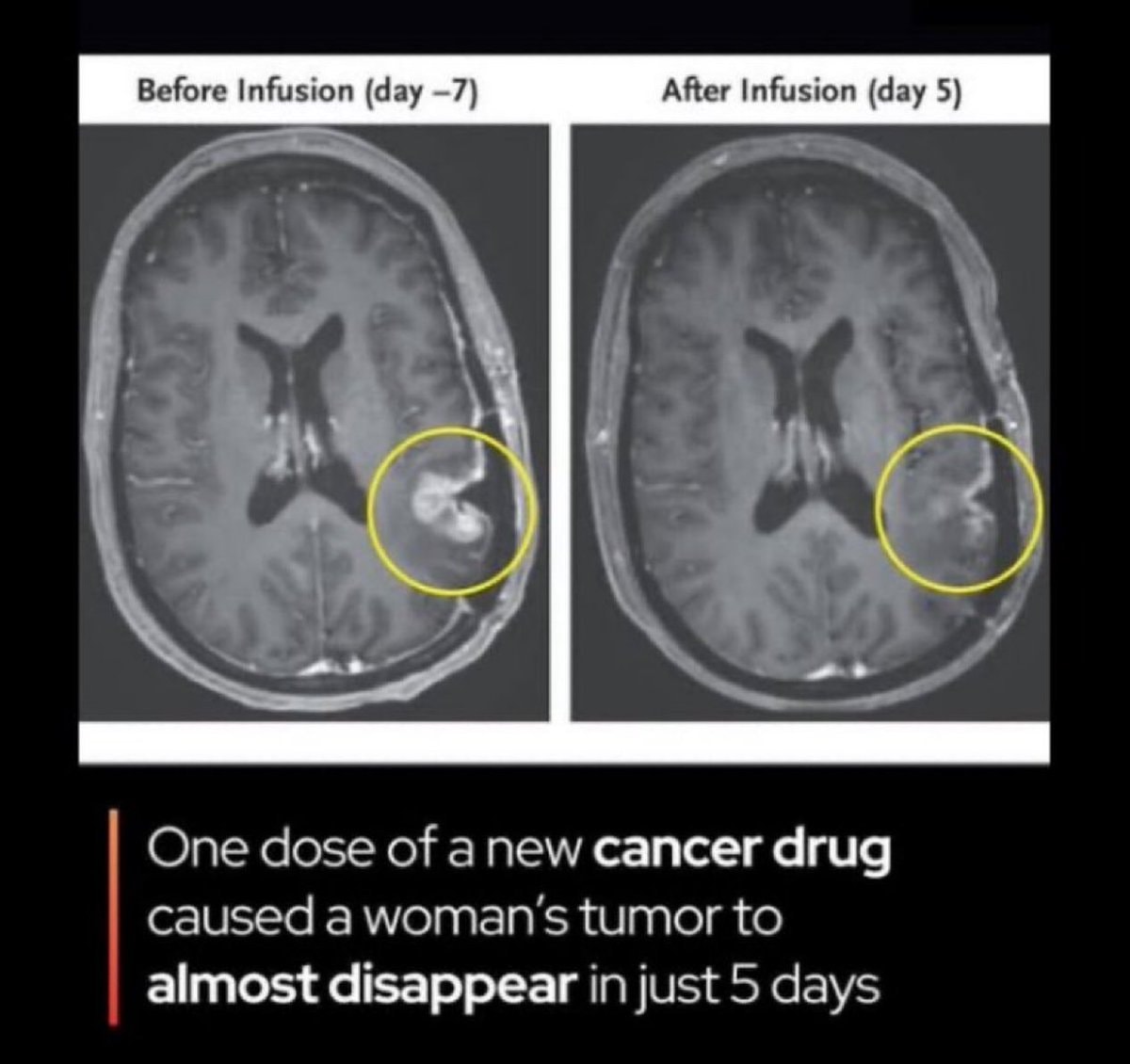 CARv3-TEAM-E glioblastoma trial MRI results CARv3-TEAM-E glioblastoma trial MRI results