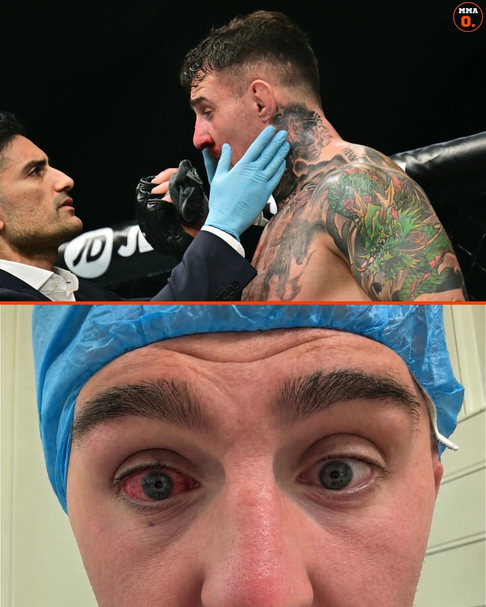 Tom Aspinall eye injury update Tom Aspinall eye injury update