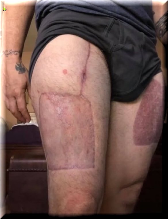 Debate over thigh skin graft procedure