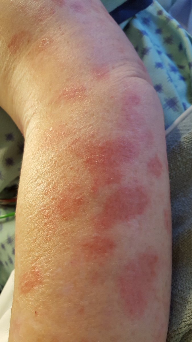 Chile eliminates leprosy WHO (photo 2 of 2)
