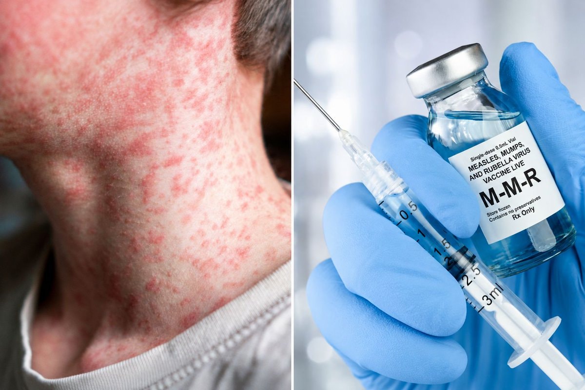 Pennsylvania measles outbreak M-M-R vaccine