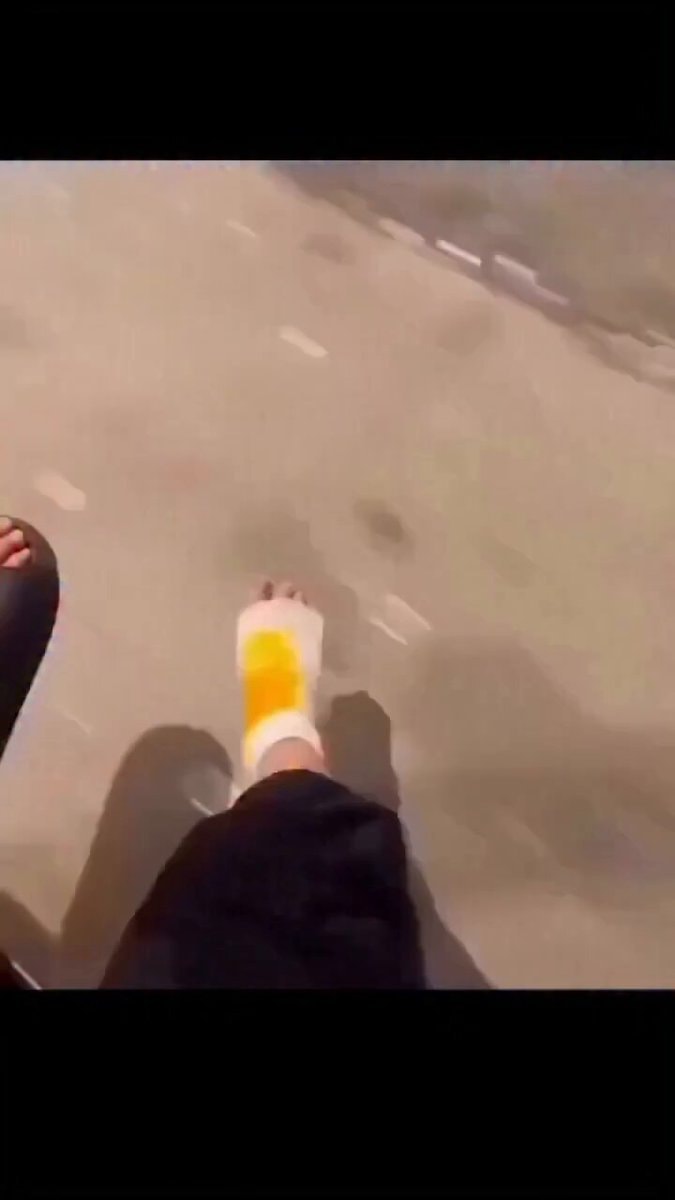 leg in cast