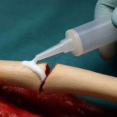 Bone glue fracture repair (photo 2 of 2)