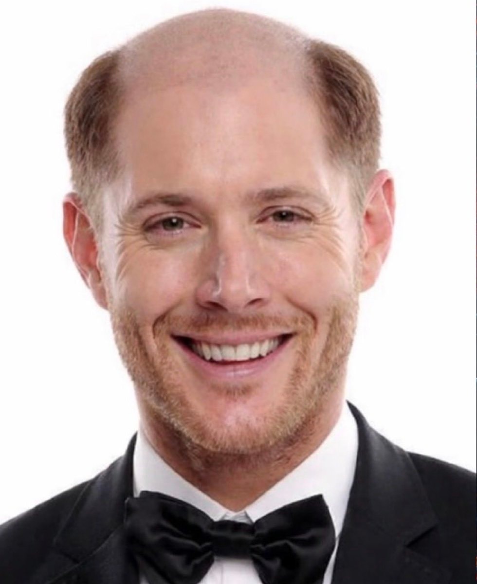 Jensen Ackles pre hair transplant photo