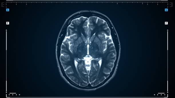 NFL players CTE study findings