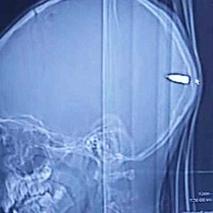 Man cured of OCD after gunshot