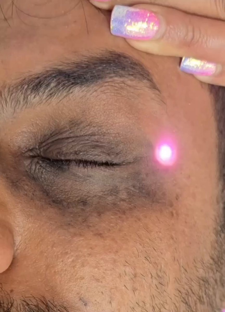 Laser treatment for pigmented dark circles Laser treatment for pigmented dark circles