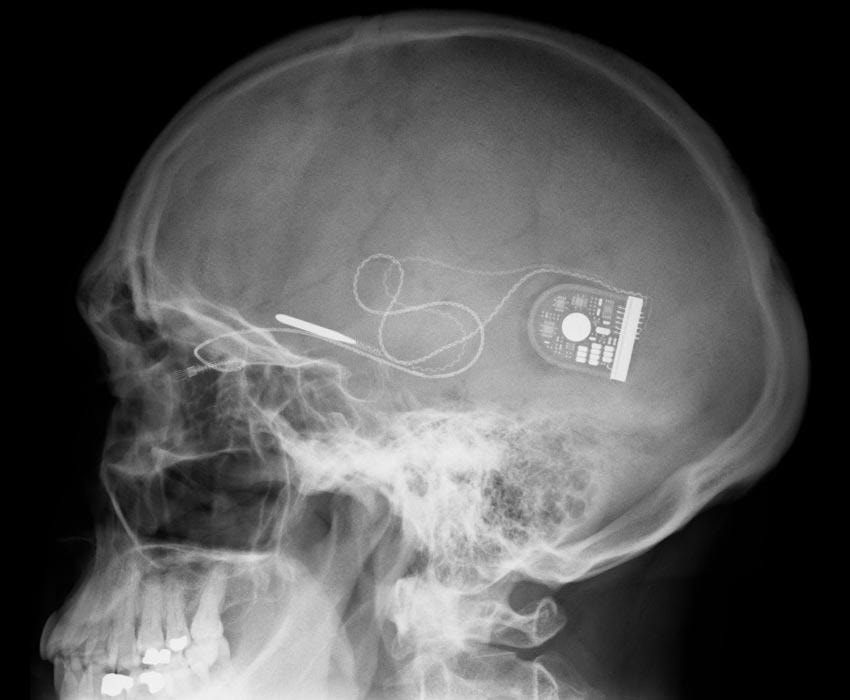 new brain implant restores vision (photo 2 of 2)