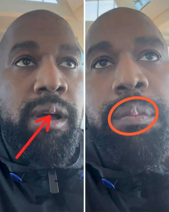 Kanye West lip growth spotted
