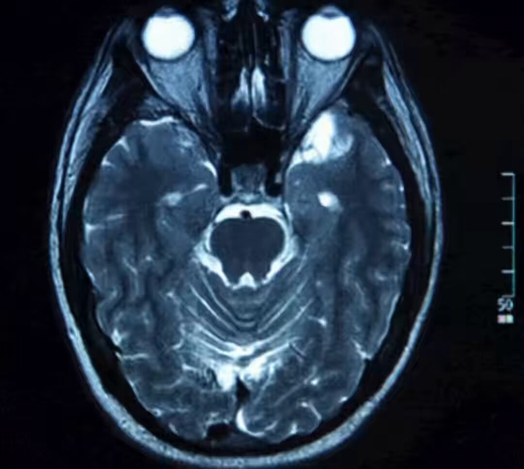 MRI scan brain neuroplasticity