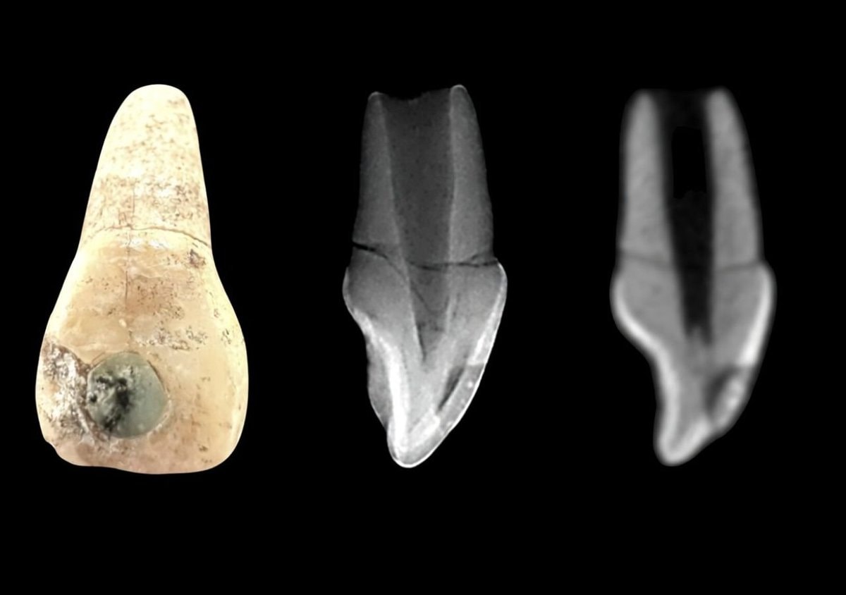 Mayan jade tooth inlays (photo 2 of 2)