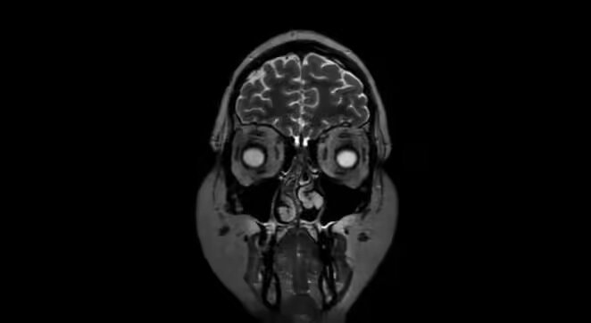 prefrontal cortex MRI scan