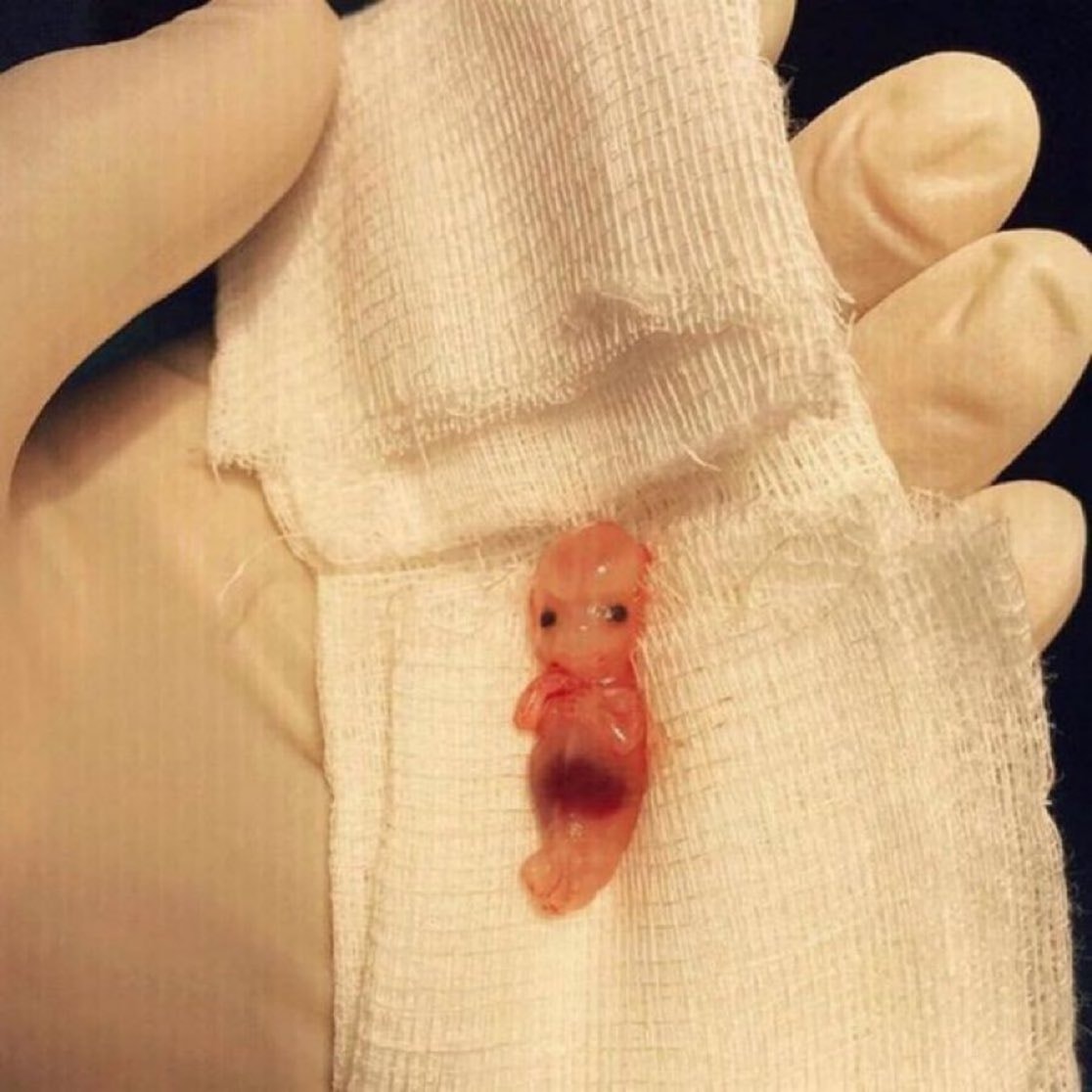 Ectopic pregnancy 9-week fetus