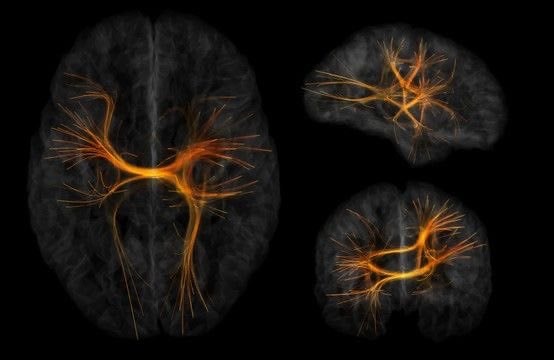 brain rewiring negativity study (photo 2 of 2)