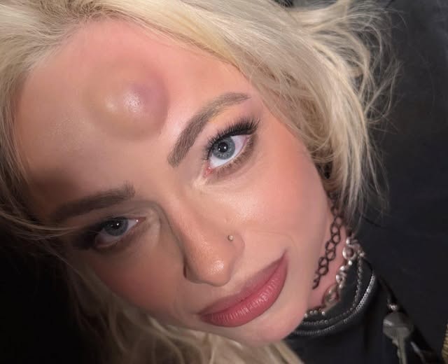 Liv Morgan hematoma recovery update