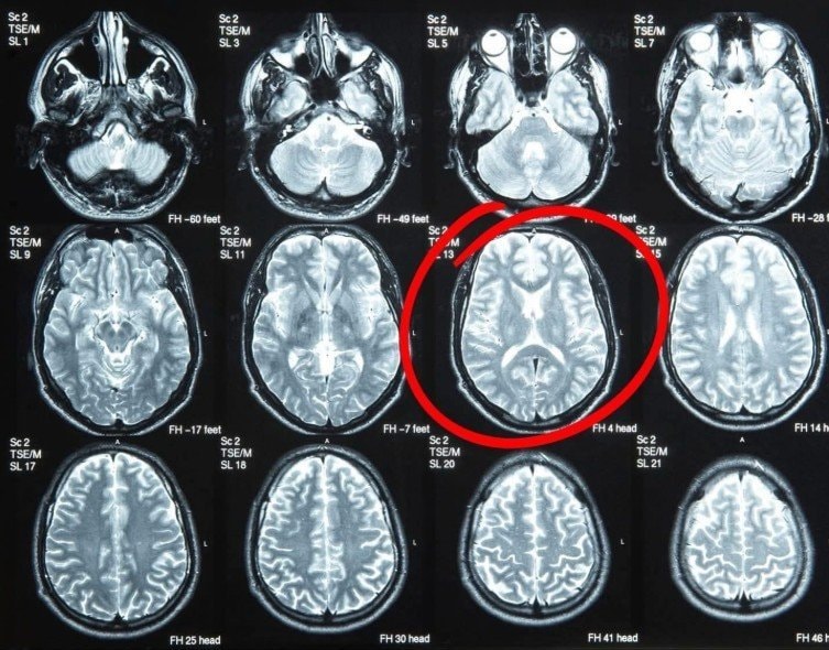 Silence regenerates brain tissue (photo 2 of 2)