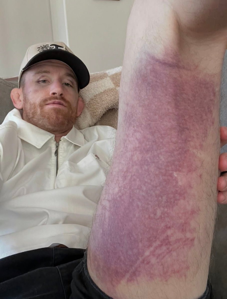 Cory Sandhagen leg injury UFC 329