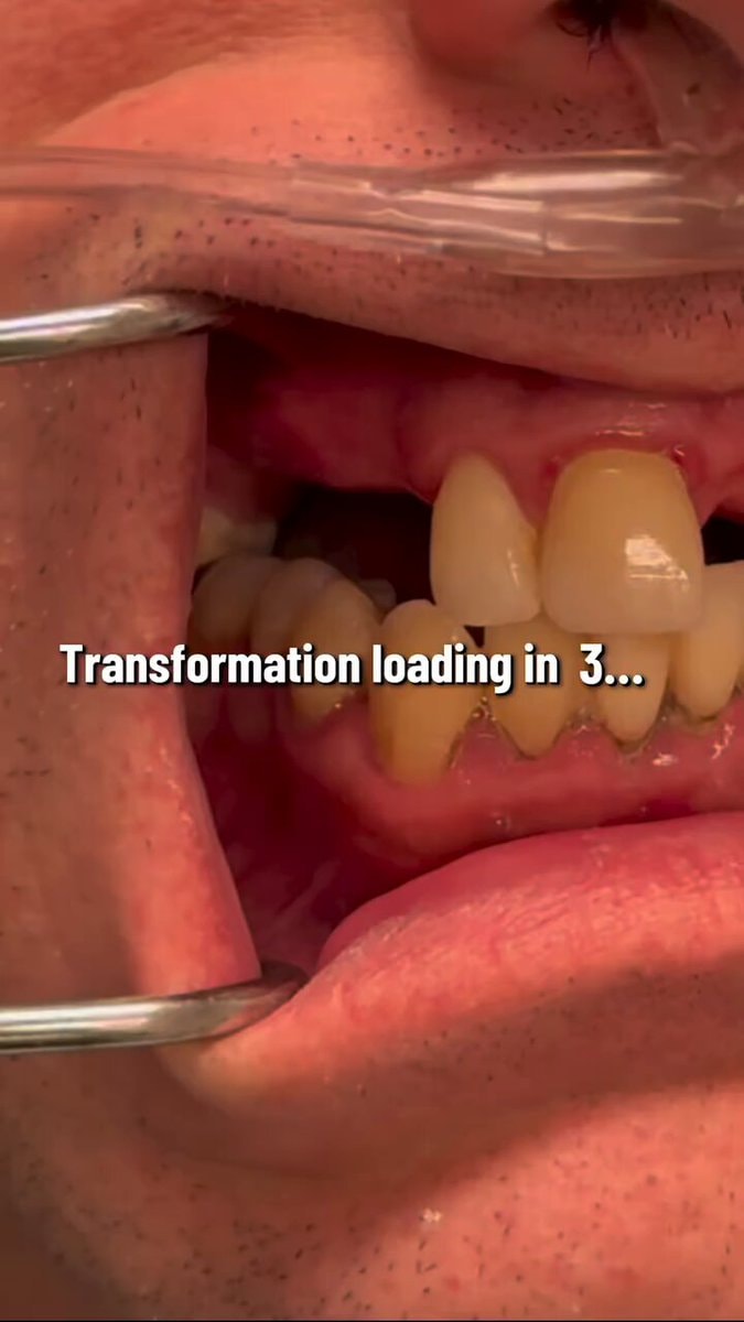 New teeth transformation New teeth transformation