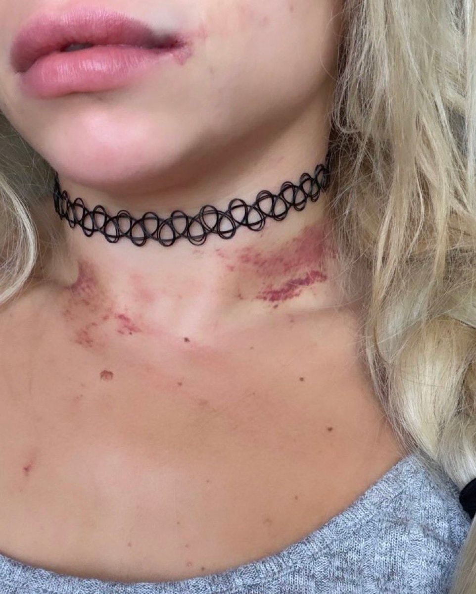 Liv Morgan bruised after WWE SmackDown Liv Morgan bruised after WWE SmackDown