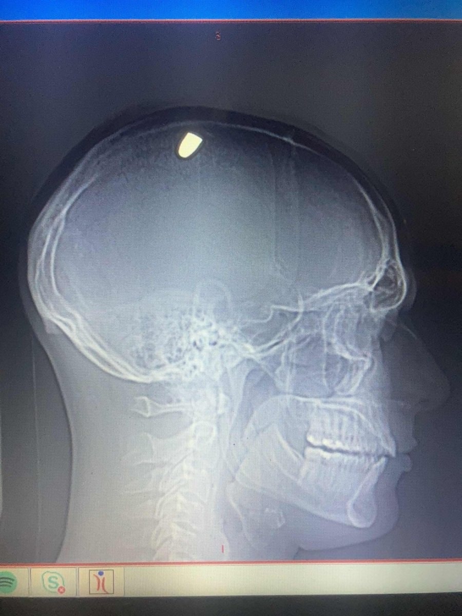 Man cured of OCD after gunshot (photo 2 of 2)