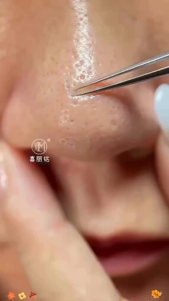 Blackhead extraction with cell extractor tweezers
