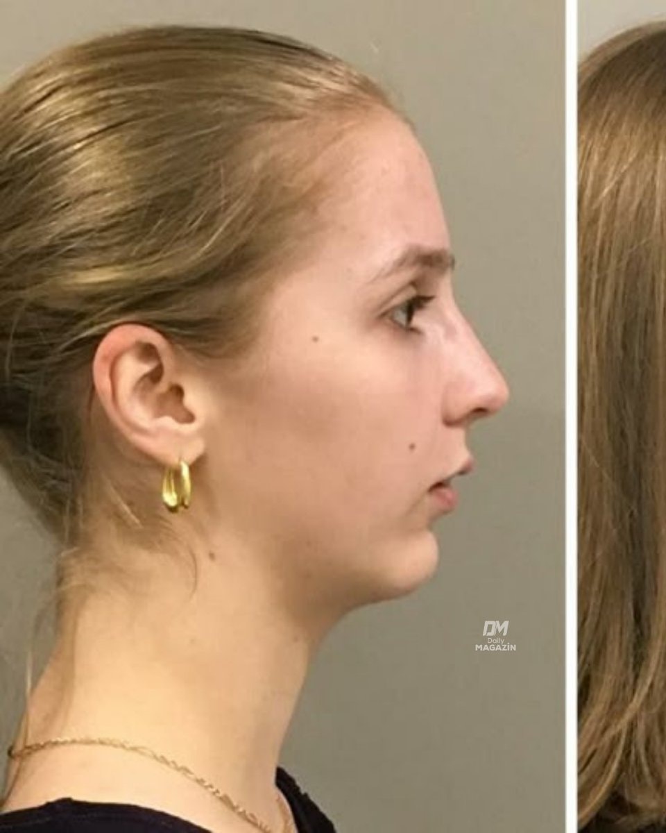 Chin filler surgery transformation (photo 2 of 2)