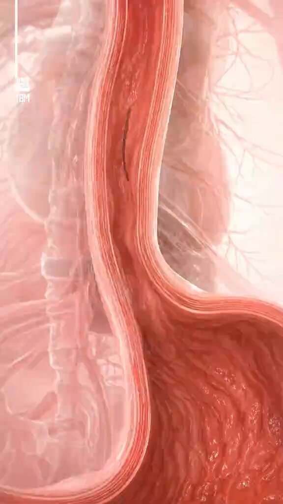 what happens to swallowed hair