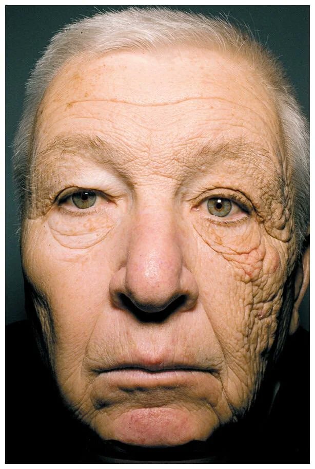 truck driver sun exposure aging truck driver sun exposure aging