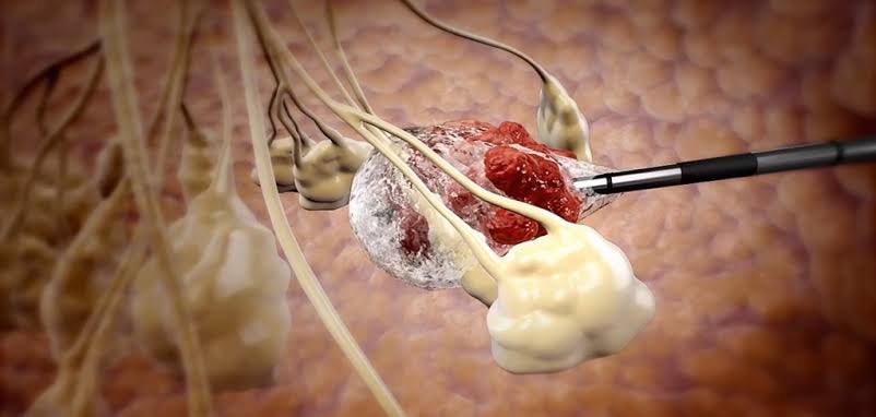 Australia tumor freezing treatment no surgery (photo 2 of 2)