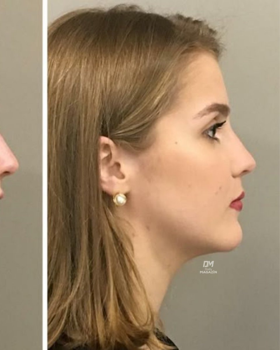 Chin filler surgery transformation