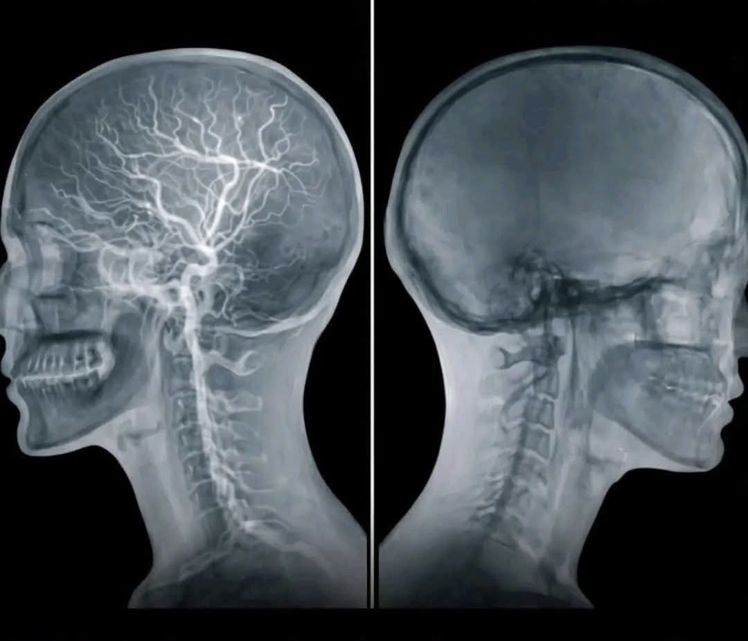 coma vs brain death scans