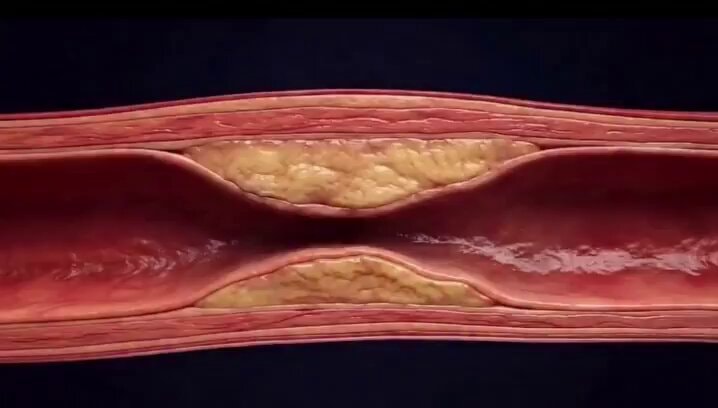 heart attack procedure saves 600,000