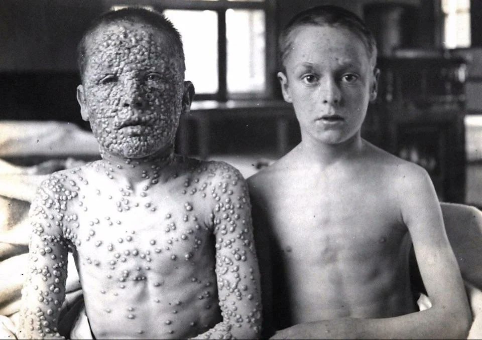 Smallpox vaccination outcome comparison