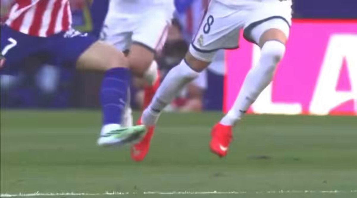 Valverde grade 3 ankle sprain