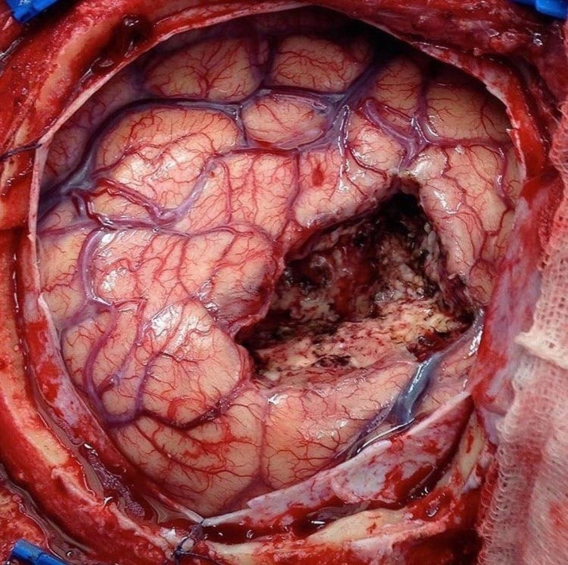 Brain tumor removal surgery (photo 2 of 2)